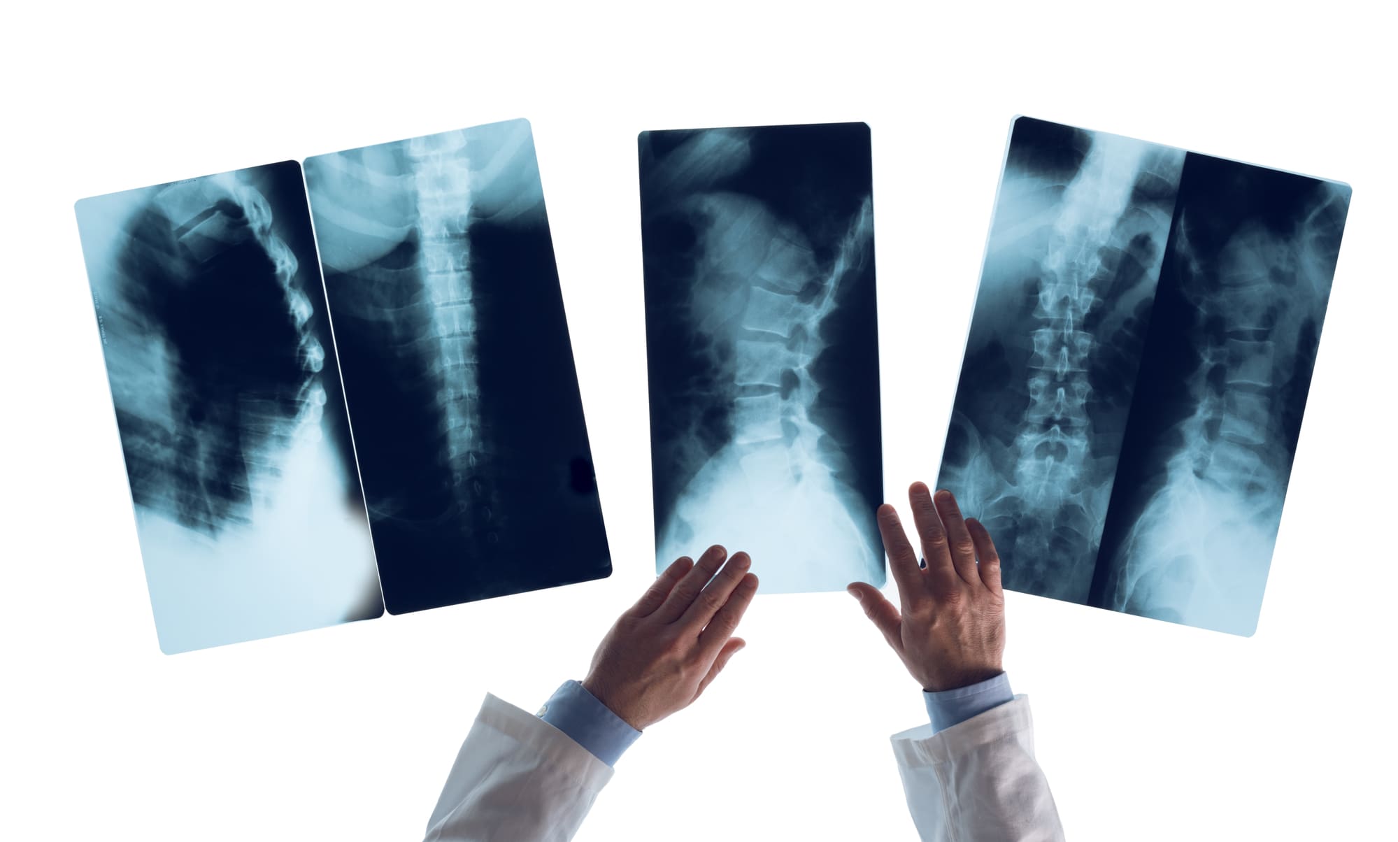 Depositphotos_88231060_L (1) disc herniation