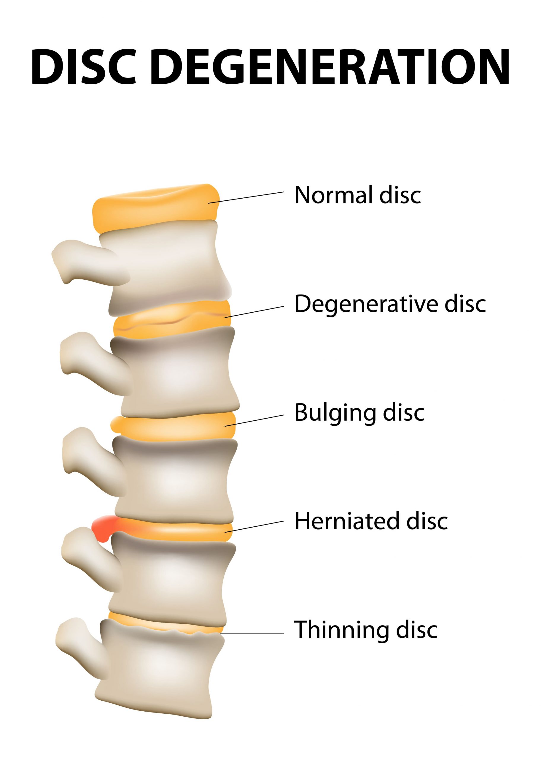 disk3 disc degeneration